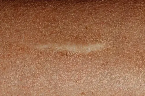 honey dressing for wound healing
